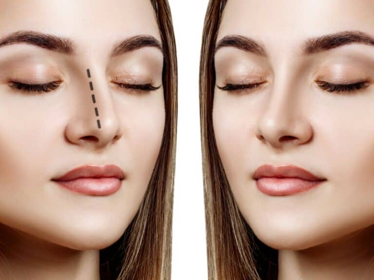 Makeup after rhinoplasty